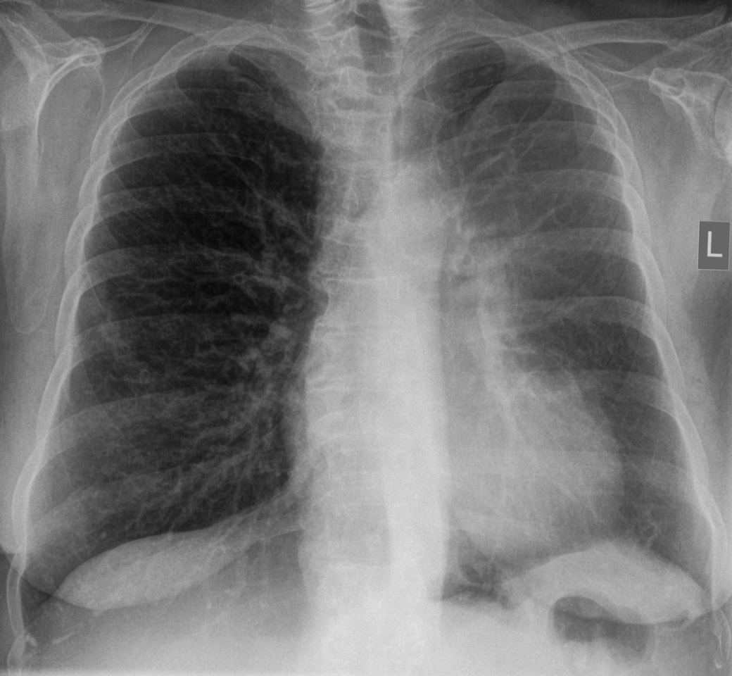 Misdiagnosing Asbestosis as Chronic Heart Failure